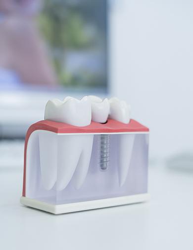 Procedimento de reabilitação com implantes dentários na clínica Aline Guzzi