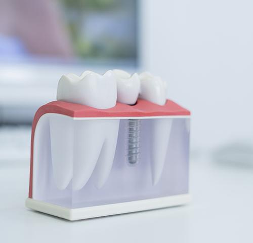 Procedimento de reabilitação com implantes dentários na clínica Aline Guzzi